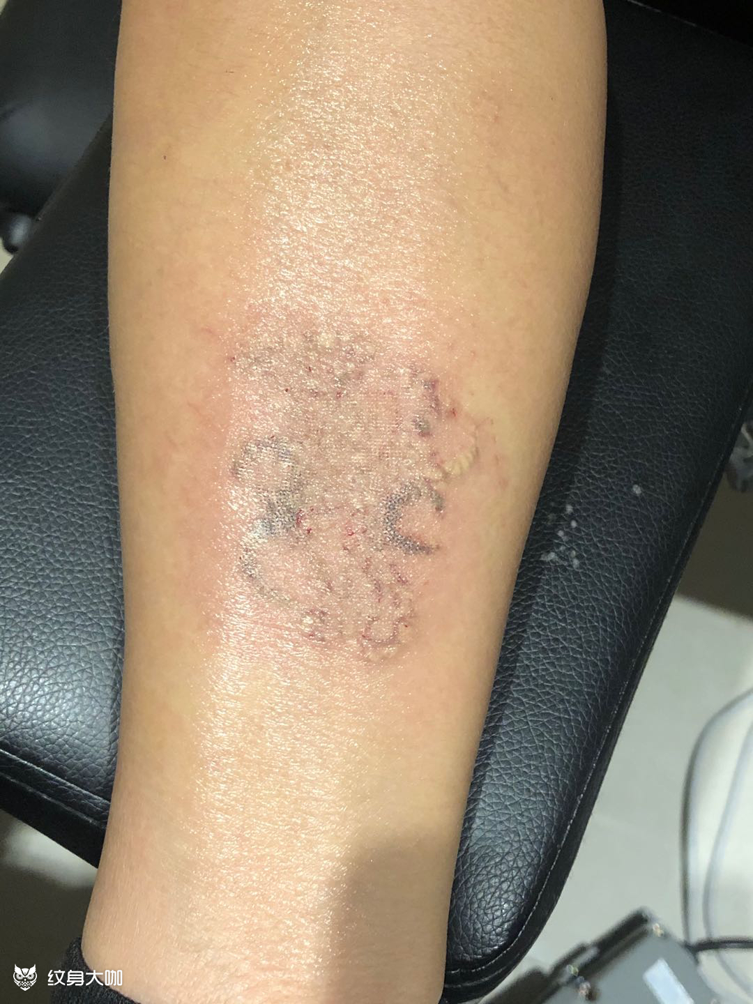 超皮秒洗纹身一次效果