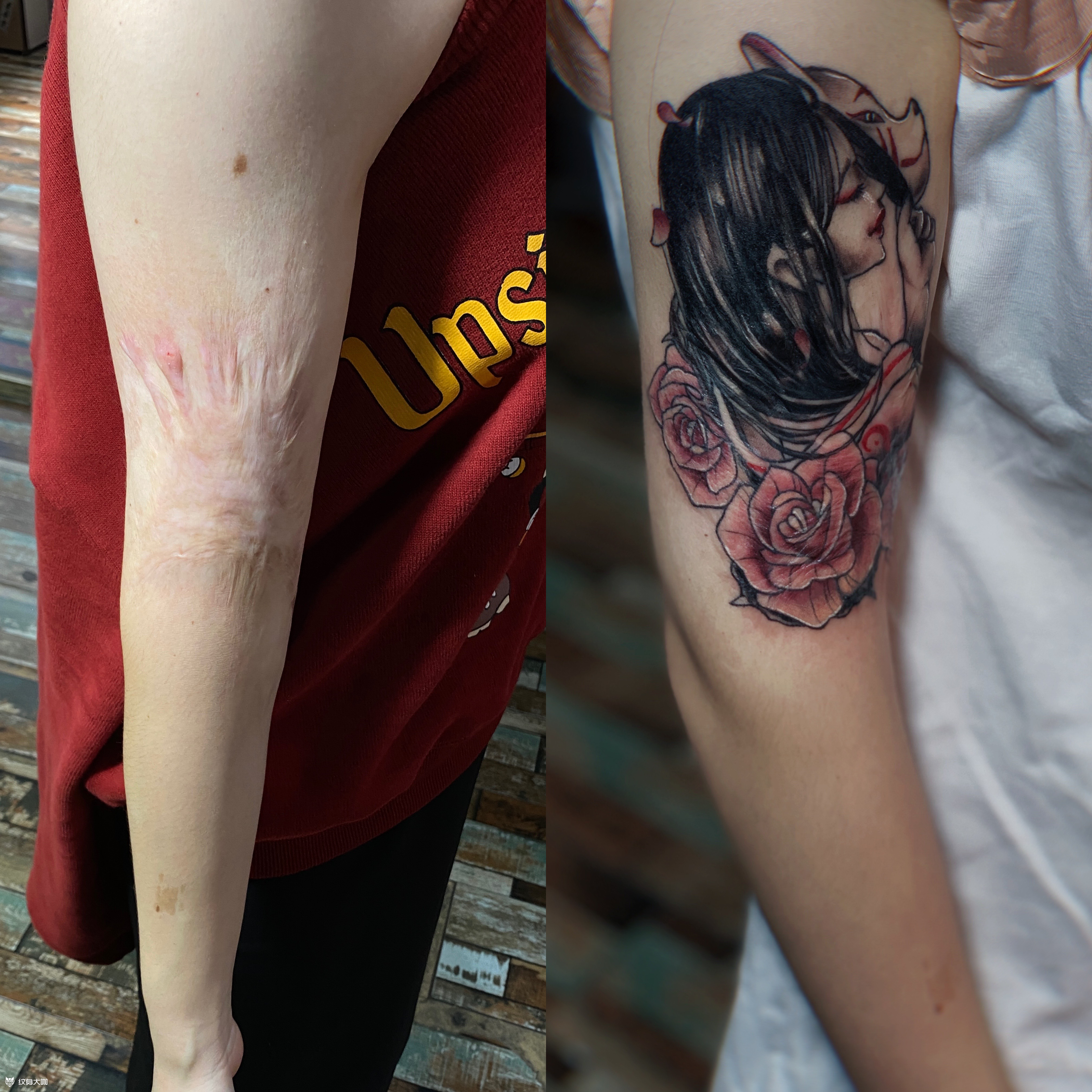 遮盖小时候的开水烫疤痕,小姐姐_纹身吧社区 - 纹身大咖