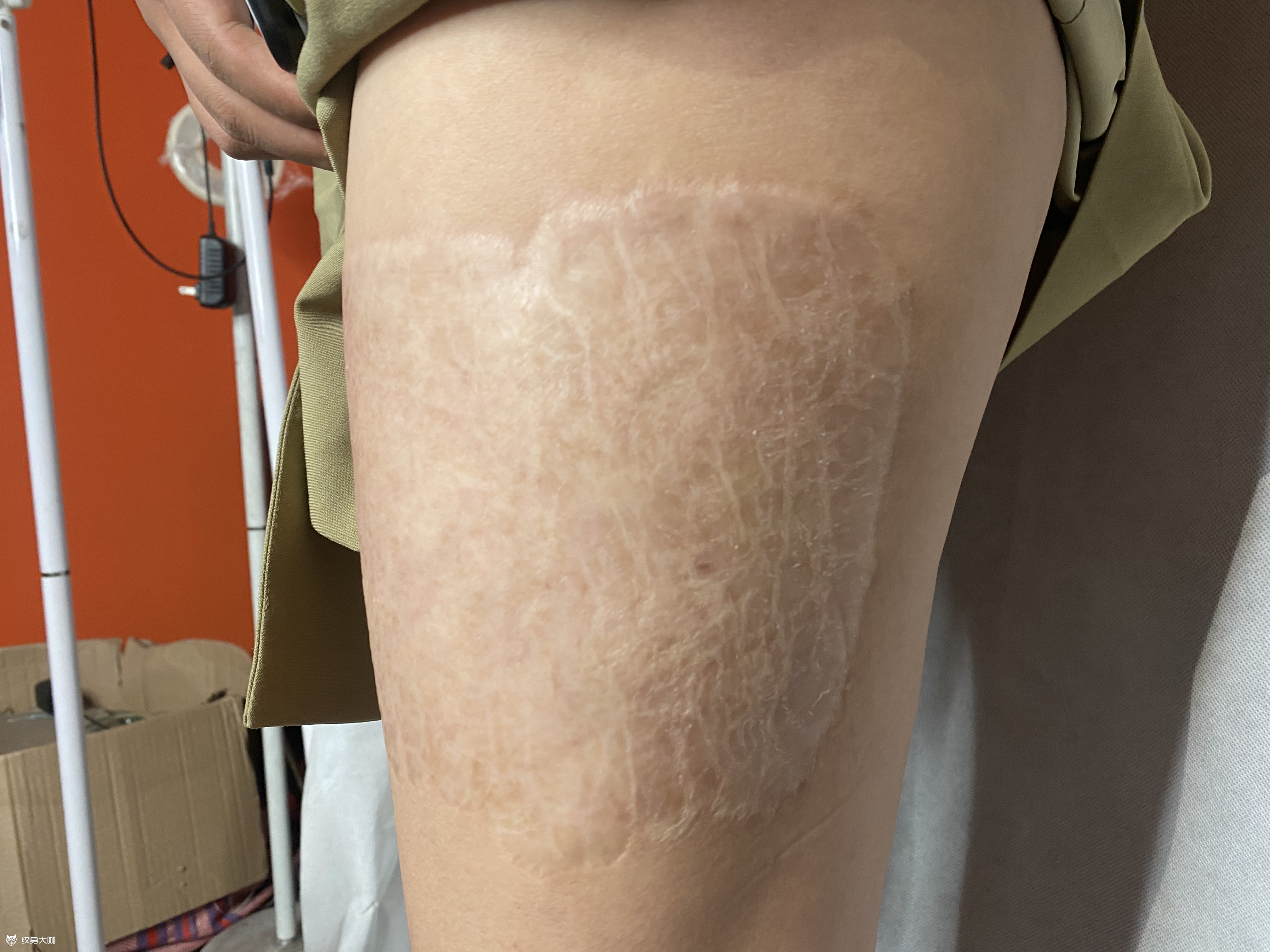 【水母】疤痕遮盖遮盖顾客小时_纹身吧社区 - 纹身大咖