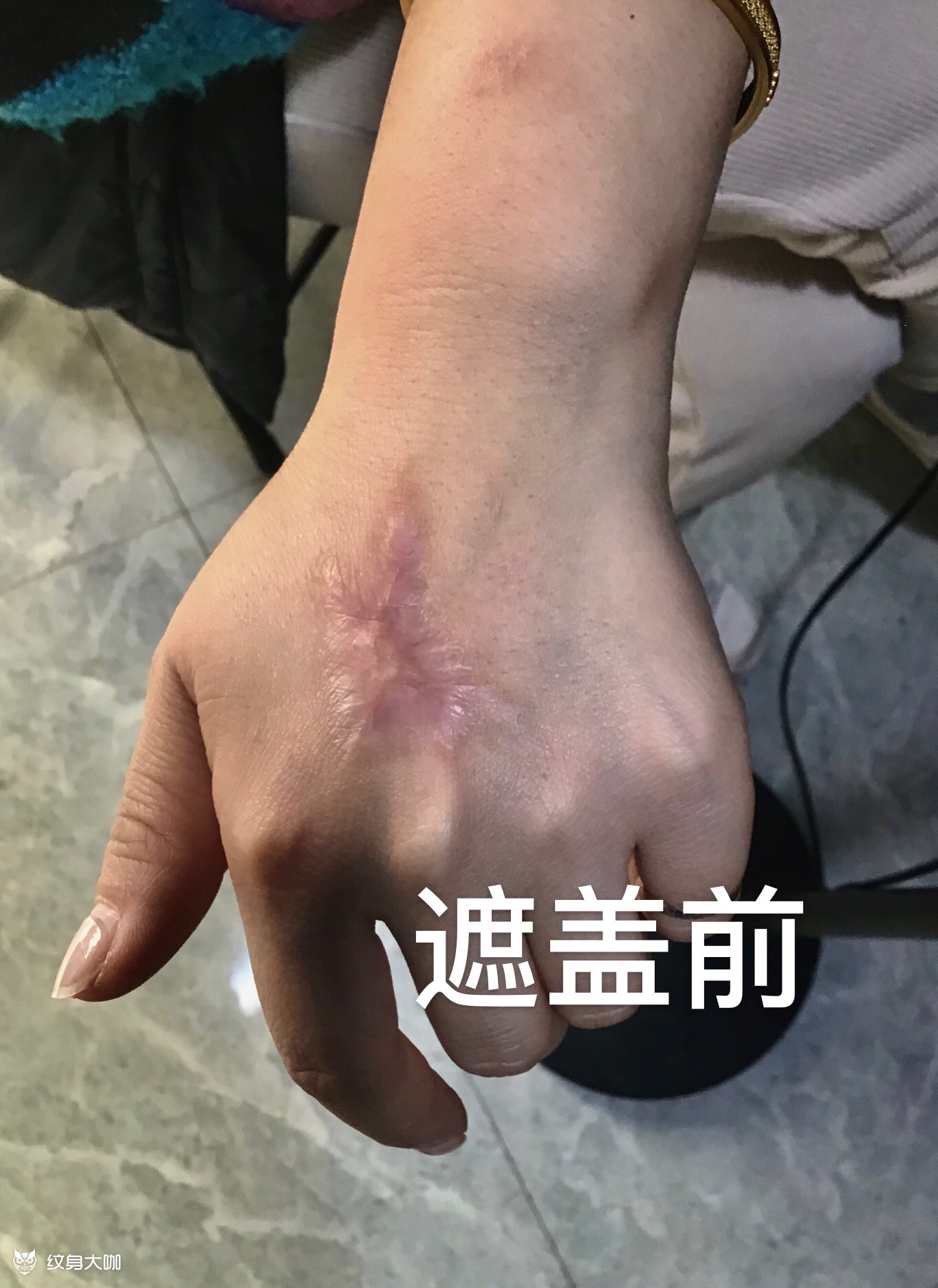 手背水墨花遮盖疤痕