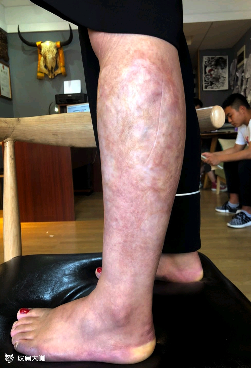 遮盖烫伤疤九尾狐