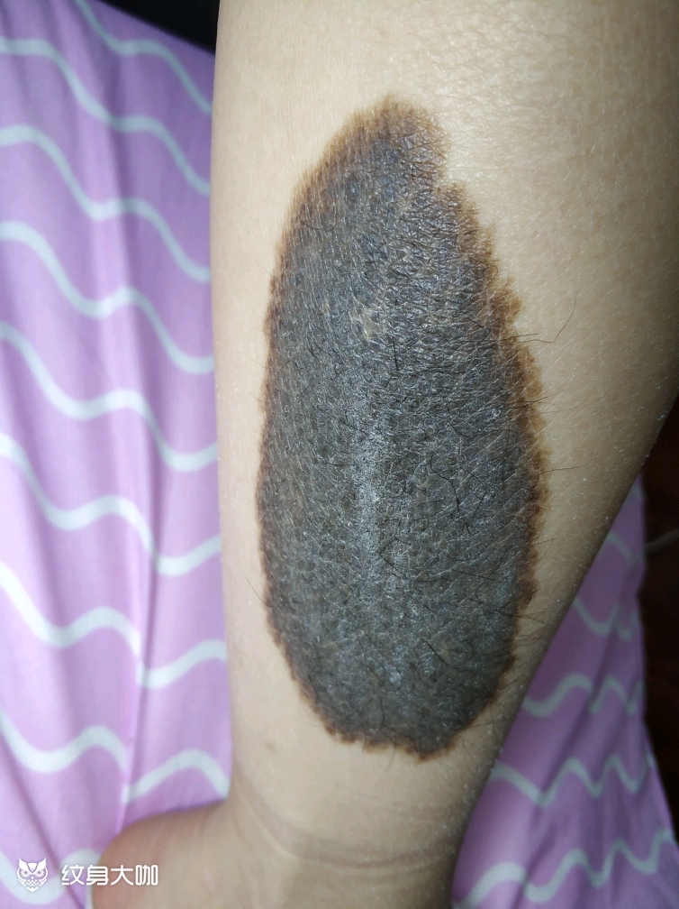 黑猫遮盖胎记,终于可以穿裙子了 这个黑色的胎记困扰了美女22年,她