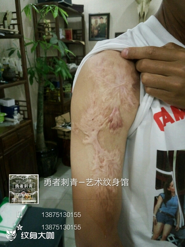 作品简介:客人小时候开水烫伤,植皮太贵,最后选择纹身遮盖
